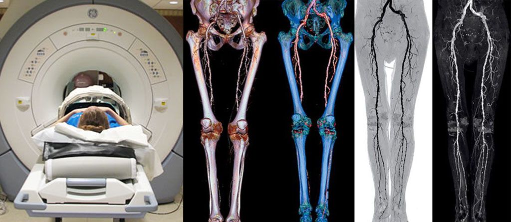 Мрт ноги. Кт ангиография сосудов нижних конечностей. Кт вен нижних конечностей с контрастированием. Магнитно-резонансная ангиография сосудов нижних конечностей.
